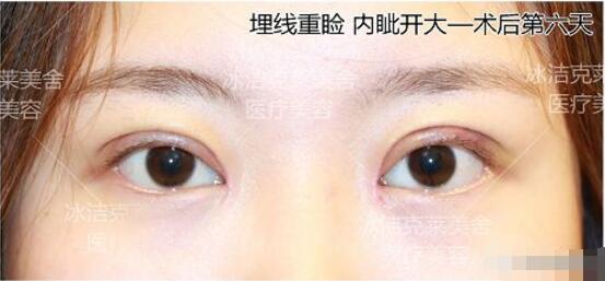 張冰潔埋線雙眼皮 開眼角術后果圖