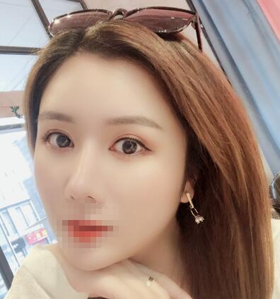 日本福田整形福田慶三雙眼皮案例