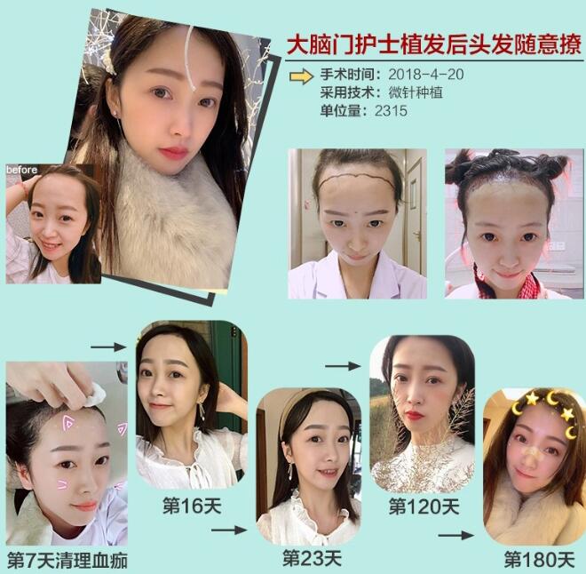 科發(fā)源微針植發(fā)怎么樣