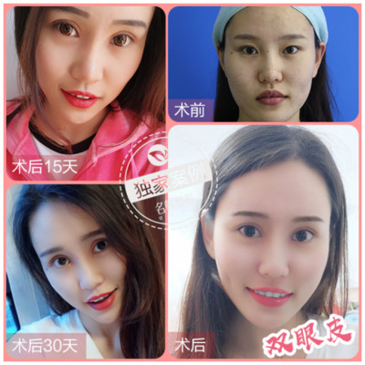 名韓整形雙眼皮案例