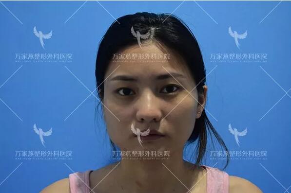 肥胖下頜角整容術(shù)前照