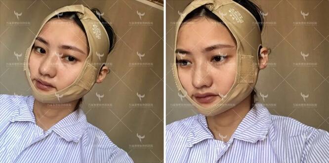 肥胖下頜角整容