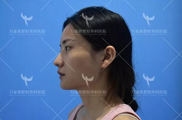 肥胖下頜角整容術(shù)前照