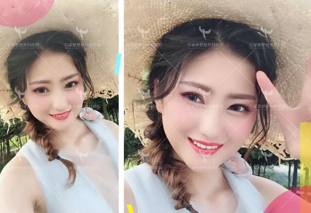 王珍祥肥胖下頜角整容案例圖