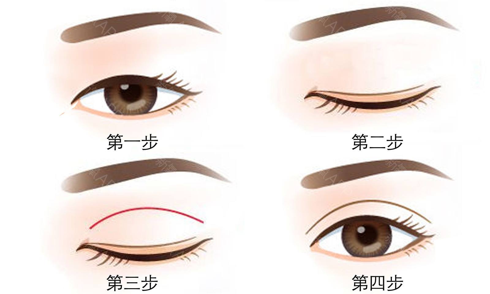 激光雙眼皮手術(shù)到底是啥？盤(pán)點(diǎn)一下這個(gè)神奇的技術(shù)