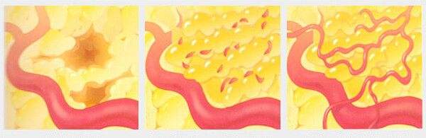 脂肪變廢為寶！脂肪轉移術把多余的脂肪填補到正確的位置