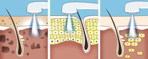 像素激光祛痘得做幾次？祛痘的正確打開方式~
