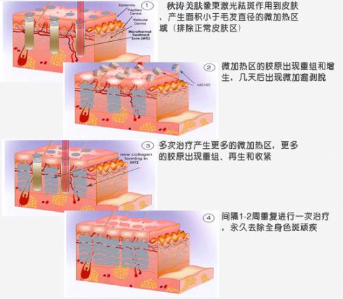 像素激光祛痘得做幾次？祛痘的正確打開方式~