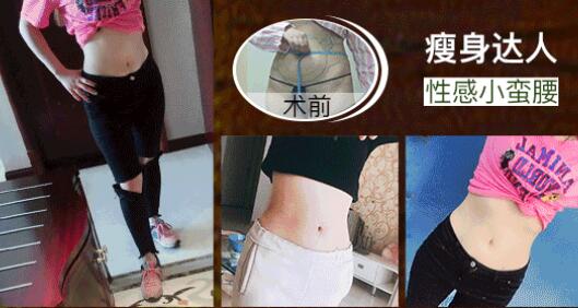 全身吸脂手術(shù)注意事項(xiàng)