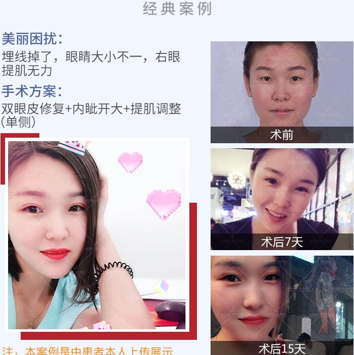 雙眼皮失敗修復