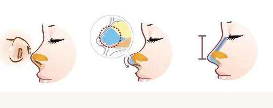 鼻頭塑形是什么項(xiàng)目？精致的鼻子鼻頭好看很重要！