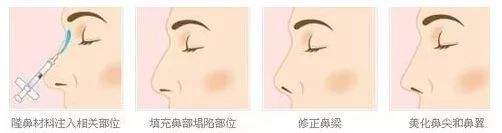 鼻頭塑形是什么項(xiàng)目？精致的鼻子鼻頭好看很重要！