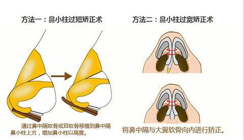 鼻頭塑形是什么項(xiàng)目？精致的鼻子鼻頭好看很重要！