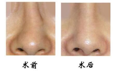 鼻梁歪整形手術果，讓你的鼻子“改邪歸正”