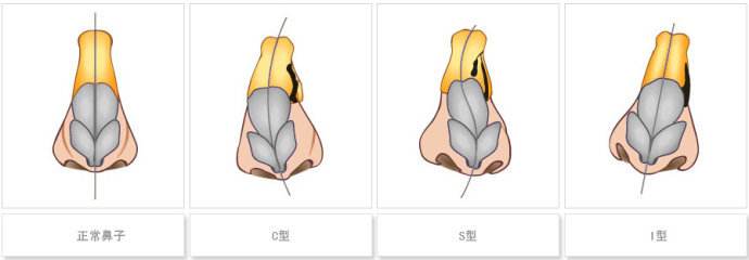鼻梁歪整形手術果，讓你的鼻子“改邪歸正”