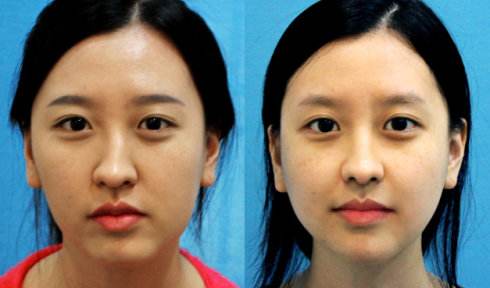 鼻梁歪整形手術果，讓你的鼻子“改邪歸正”