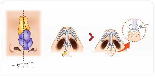 鼻梁歪整形手術果，讓你的鼻子“改邪歸正”