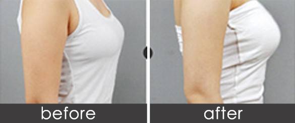 假體隆胸方法靠譜嗎、沒問題嗎？你想知道的都在這兒