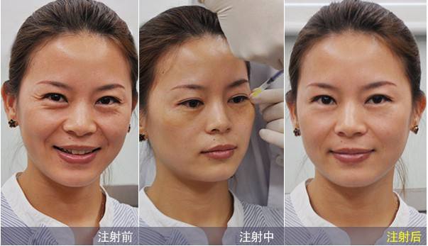 消除魚尾紋的方法有哪些？別信網(wǎng)上那些小偏方啦！