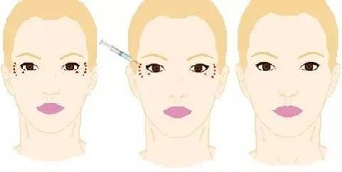 消除魚尾紋的方法有哪些？別信網(wǎng)上那些小偏方啦！