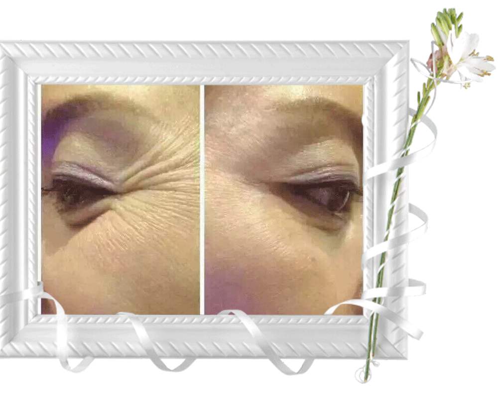 消除魚尾紋的方法有哪些？別信網(wǎng)上那些小偏方啦！