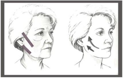 消除魚尾紋的方法有哪些？別信網(wǎng)上那些小偏方啦！