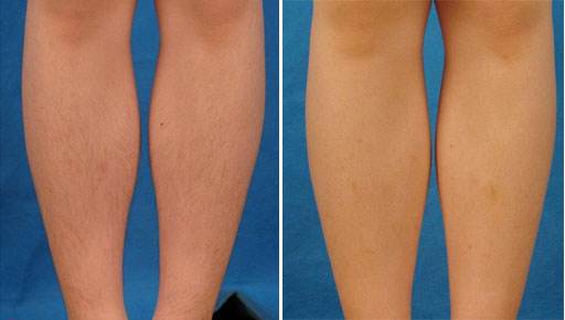 怎么樣脫毛才能夠沒問題又徹底？這個方法可以一勞永逸！