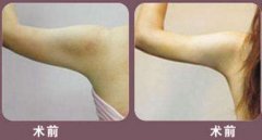 [吐血整理]北京地區(qū)抽脂減肥價格一覽表！吸脂項目大全~