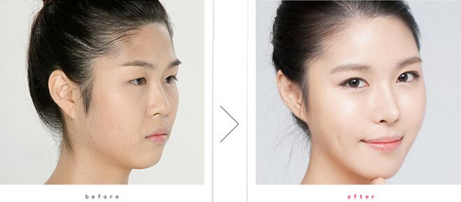 只想隆鼻，醫(yī)生還讓做鼻尖成形術？是被坑了嗎…