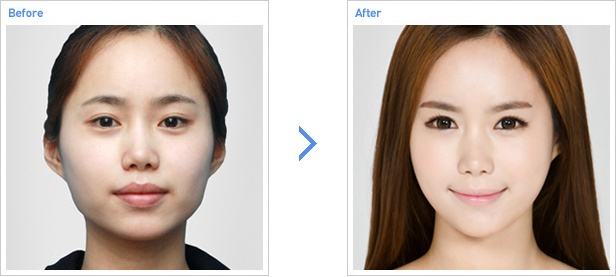 臉部輪廓整形大概多少錢？術(shù)后會留下后遺癥嗎？