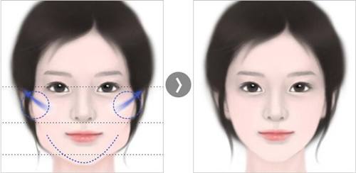 臉部輪廓整形大概多少錢？術(shù)后會留下后遺癥嗎？