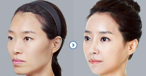 臉部輪廓整形大概多少錢？術(shù)后會留下后遺癥嗎？