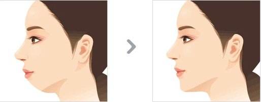 臉部輪廓整形大概多少錢？術(shù)后會留下后遺癥嗎？