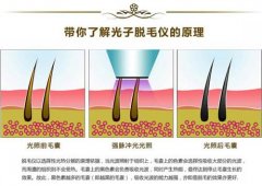 光子脫毛的危害是什么？擊破謠言，真相在這里~