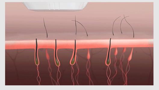 光子脫毛的危害