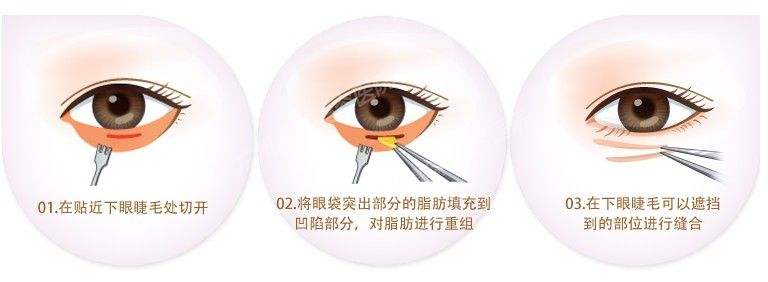 盤點(diǎn)一下抽脂去眼袋費(fèi)用 果和維持時(shí)間