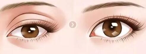 眼窩脂肪填充手術有硬塊怎么辦?