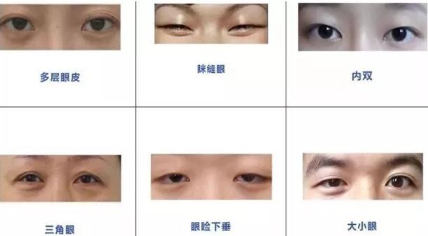 內(nèi)雙可以割雙眼皮嗎？看看專家怎么說