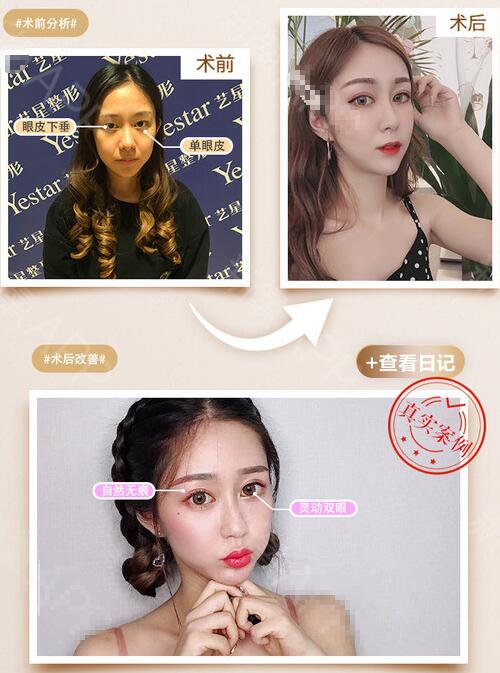 內(nèi)雙可以割雙眼皮嗎 案例圖