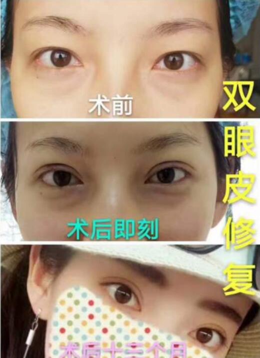 青海省人民醫(yī)院劉世杰醫(yī)生雙眼皮修復案例