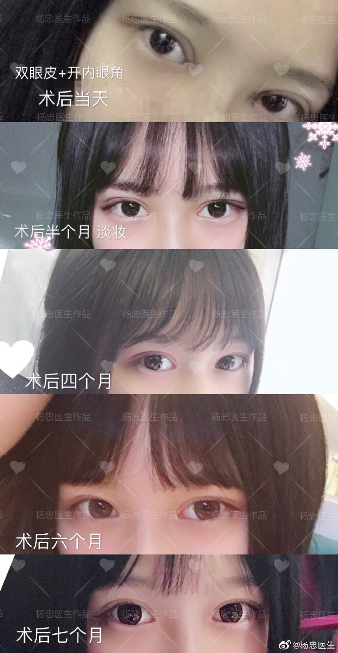 楊忠醫(yī)生雙眼皮案例圖