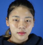 林秋蓉激光祛斑果太贊！終于擺脫“斑花”稱號了！