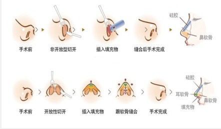 鼻翼縮小手術(shù)