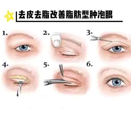 微創(chuàng)雙眼皮多久恢復(fù)自然