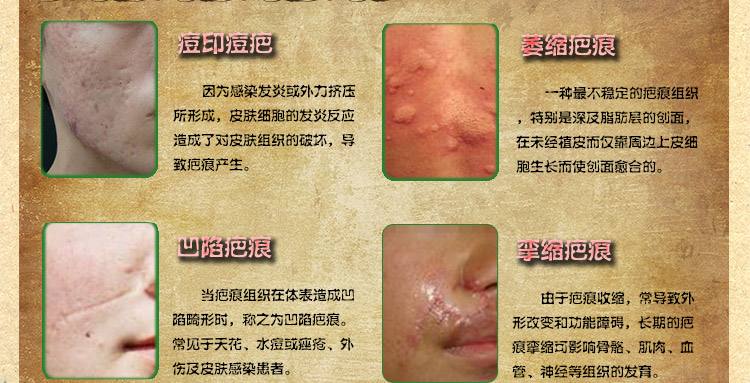 怎么去除痘印痘疤