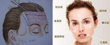 抬頭紋手術(shù)有哪些