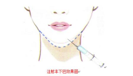 艾莉薇玻尿酸適合打哪里