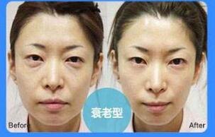 溶脂去眼袋價(jià)位