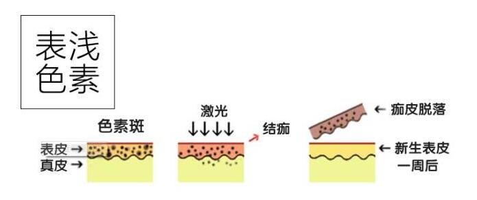 激光祛斑c6好處