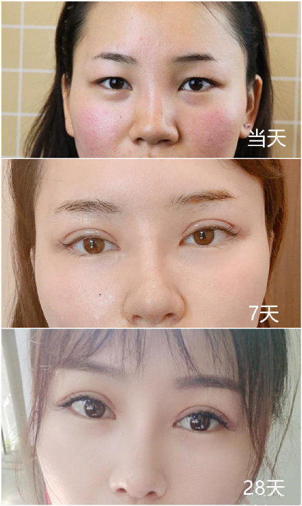 雙眼皮案例
